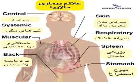 پشه ها و خطر انتقال بیماری های مختلف 4 علائم بیماری مالاریا